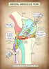 A4 Medial Meniscus Tear Printable Poster