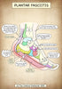 A4 Plantar Fasciitis Art Print