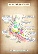 A4 Plantar Fasciitis Printable Poster