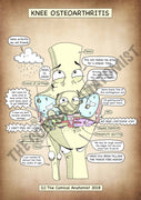 Knee Joint Osteoarthritis A4 Printable Poster
