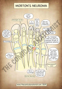 A4 Morton's Neuroma Printable Poster (Instant Download)